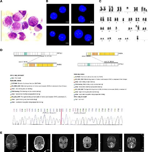 Figure From Myeloid Sarcoma Type Of Acute Promyelocytic Leukemia With