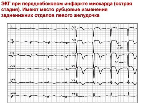 В рубцовой стадии трансмурального инфаркта миокарда - фото презентация