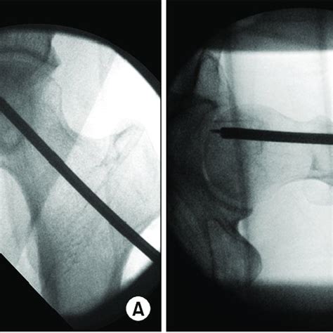 Intraoperative Anteroposterior A And Lateral B Fluoroscopic Images Download Scientific