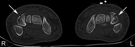 Simultaneous Bilateral Fracture Of The Triquetral Bone Bmj Case Reports