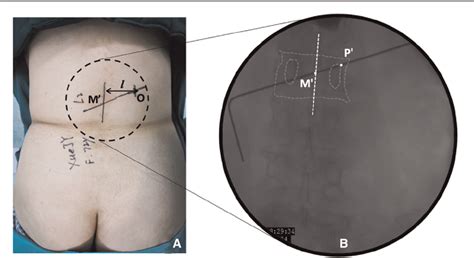 Figure 2 From A Modified Trajectory Of Kyphoplasty Via Superior Pedicle Notch For Osteoporotic