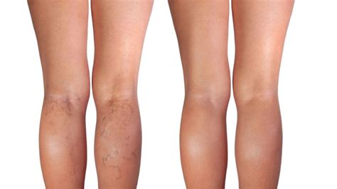 Spider Vein Removal Sclerotherapy Ottawa Medispa Trainyards