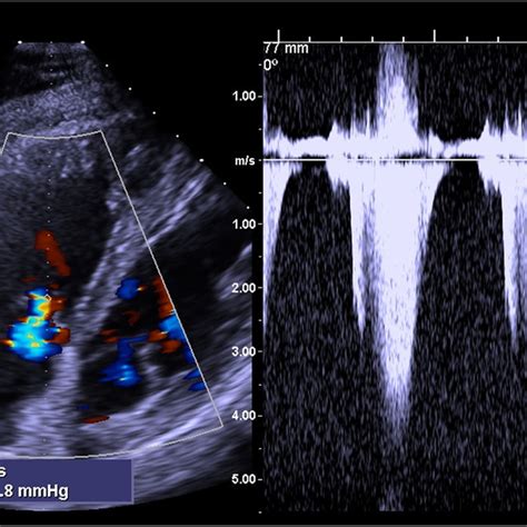 Echocardiography Shows Normal Left Ventricular Systolic Function With