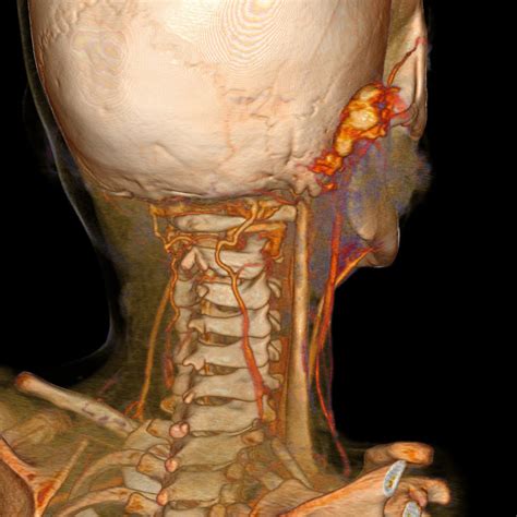 Imagenolog A Activa Angiotac De Vasos De Cuello Paciente Con