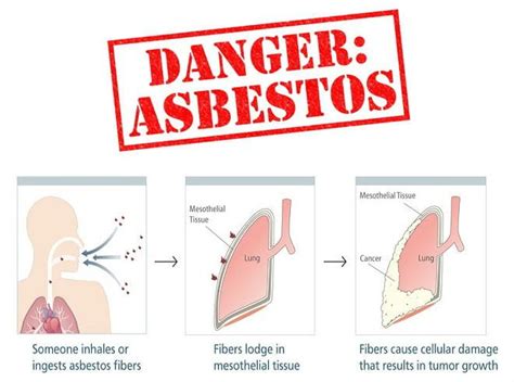 Asbestosis – Symptoms, causes and other associated risk factors