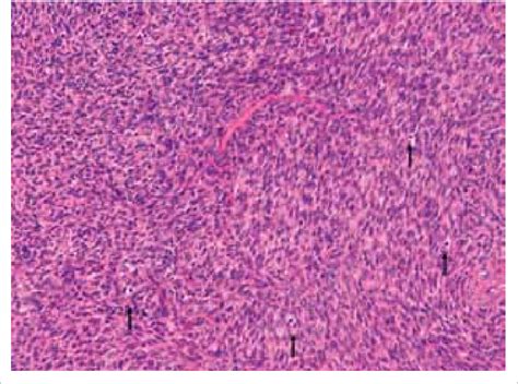 Case 1 The Tumour Was Composed Of Spindle Shaped Cells Arranged In