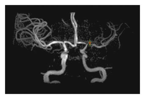 Our Patient’s Magnetic Resonance Angiogram Of The Brain The Location Download Scientific