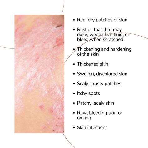 Atopic Dermatitis Eczema Dermtropics