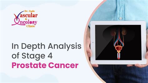 In Depth Analysis Of Stage 4 Prostate Cancer