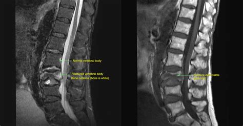 VERTEBROPLASTY FOR OSTEOPOROTIC SPINAL FRACTURES – Sydney Medical ...