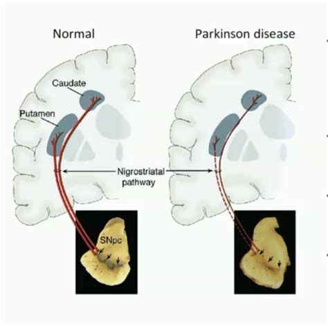 Parkinson S Disease Flashcards Quizlet