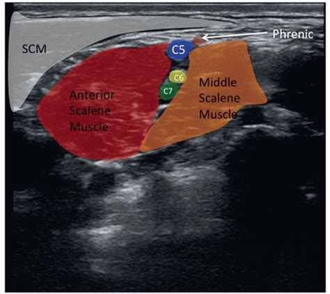 Ultrasound-Guided Phrenic Nerve Block | Anesthesia Key