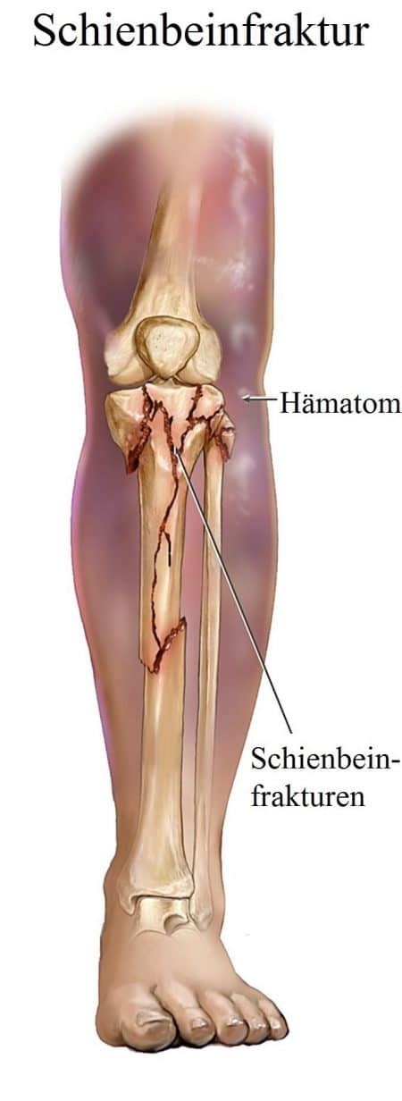 Fraktur Der Tibia Fibula Behandlung Ursache Therapie
