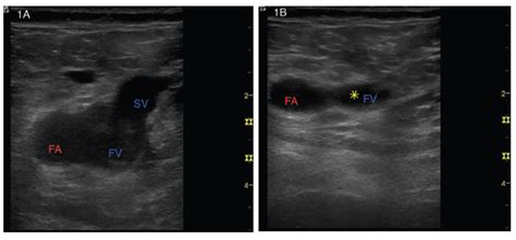 Blood Clot In Leg Ultrasound