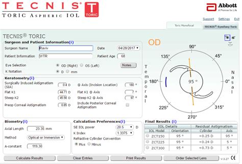 MillennialEYE | Four Steps to Toric IOL Calculation Success