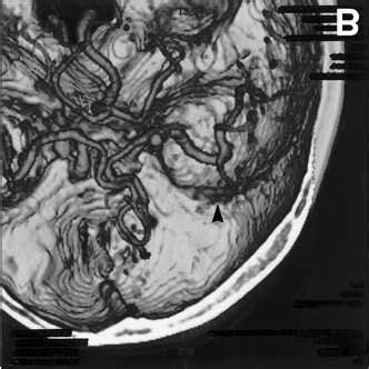 Preoperative Three Dimensional Computed Tomography Angiography 3D CTA