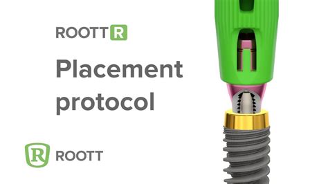 Roott R Placement Protocol Youtube