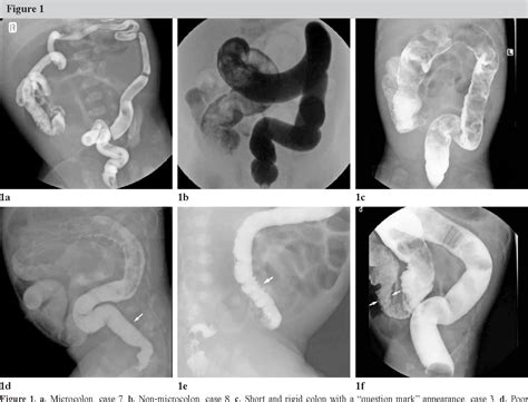 Hirschsprungs Disease Barium Enema