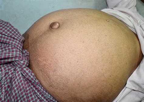 Abdominal Fat In Patient With Ascities And Paraumbilical Hernia Stock