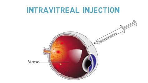 Intravitreal Injection Alolika Nursing Home