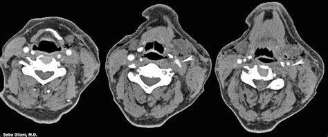 Roentgen Ray Reader Penetrating Neck Injuries