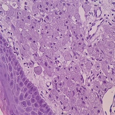 (PDF) Congenital Epulis