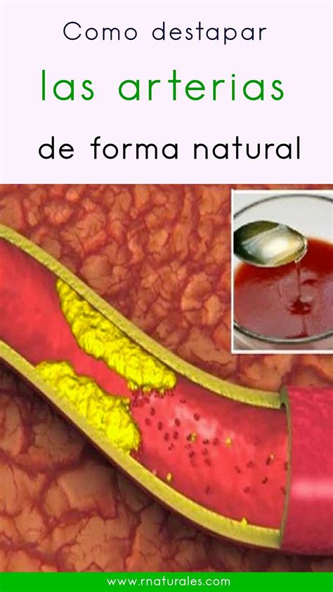 Como Destapar Las Arterias De Forma Natural Con Im Genes Remedios