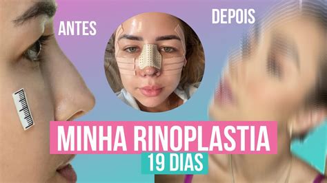 TUDO SOBRE MINHA RINOPLASTIA PRÉ E PÓS OPERATÓRIO ANTES E DEPOIS