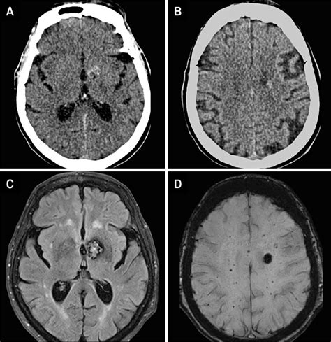 Scielo Brazil Neurocysticercosis Familial Cerebral Cavernomas And Intracranial Calcifications