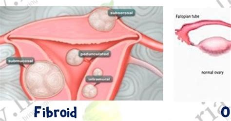 Perbezaan Antara Cyst Dan Fibroid Ramai Wanita Yang Keliru Cara