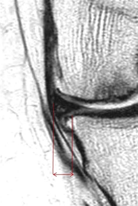 Meniscal Extrusion And Spontaneous Osteonecrosis With Root Tear Of