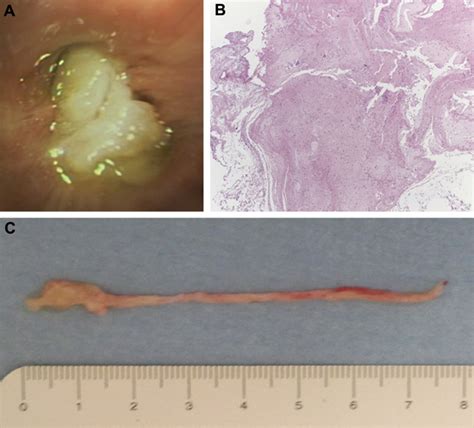 Plugs Of The Air Passages A Clinicopathologic Review Abstract