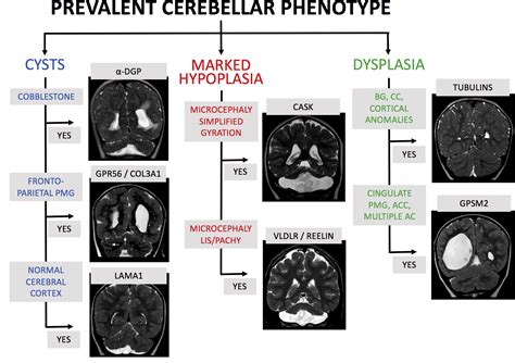 Posterior Fossa Malformations Neuroimaging Clinics