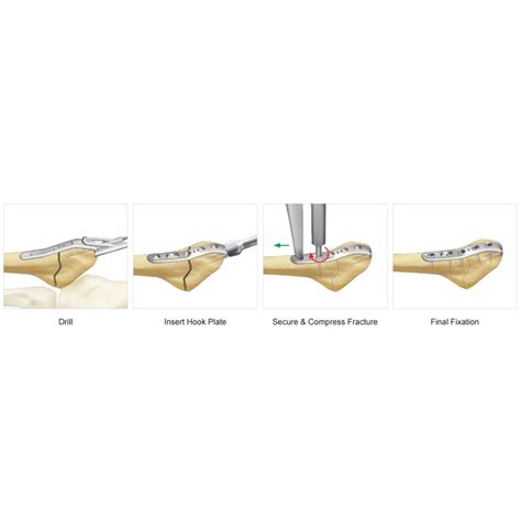 Trimed Fifth Metatarsal Hook Plate Clinilab