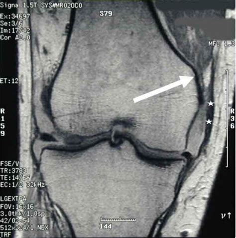 Mcl Injury Medial Collateral Ligament Tear Complex Knee Specialist