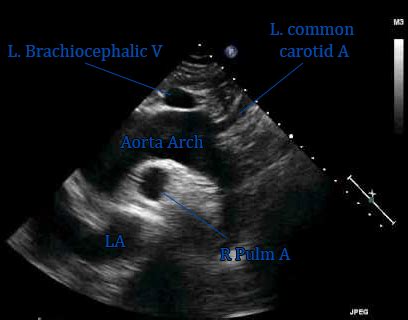 The Suprasternal Notch View – A Little Cold Gel