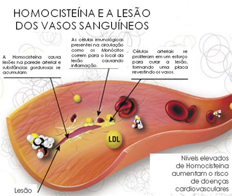 HOMOCISTEÍNA ENDONUTRY