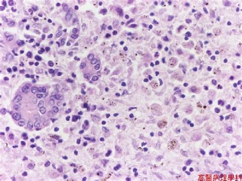 Kmu Pathology Labslide Fulminant Hepatitis Liver