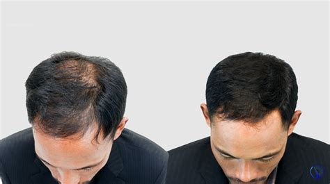 Lightvive Laser Hair Growth System Before After