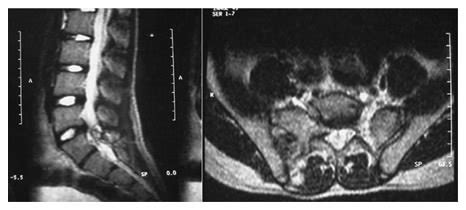 MRI showing a lesion encroaching on the sacral canal and compressing ...