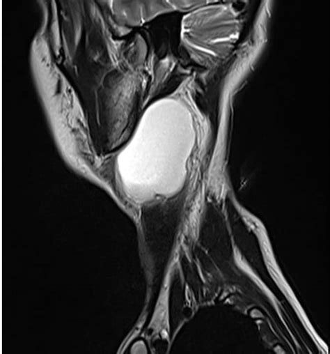 Resonancia Magnética De Cuello Centro De Diagnóstico Por Imágenes