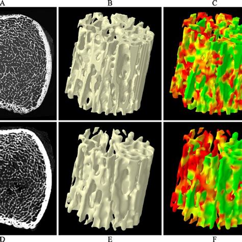 Comparison Of Trabecular Bone Tb Microstructure Using MicroCT And CT