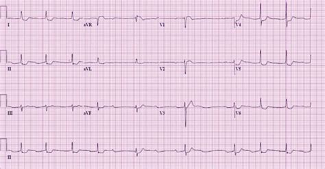 Ecg At Presentation Showed Normal Sinus Rhythm With St Elevation In