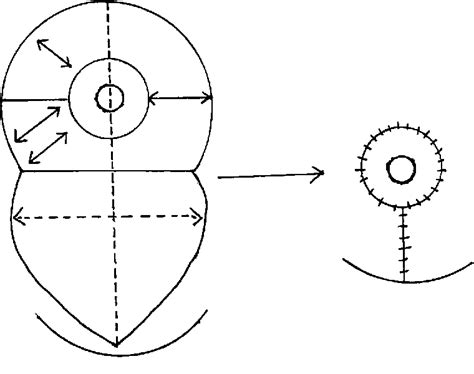 Figure 2 from Corrective Surgery for Mammary Hypertrophy on Ambulant Patients | Semantic Scholar