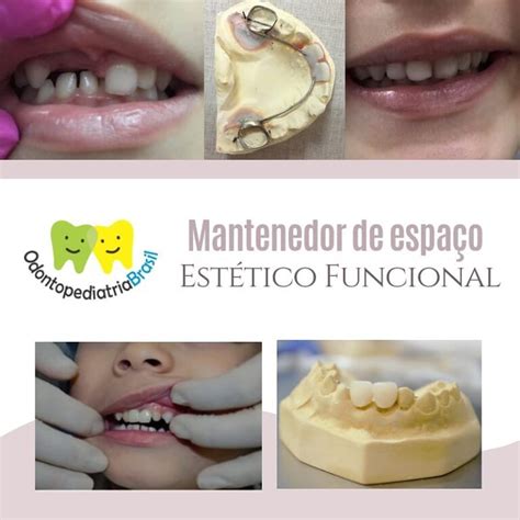 Mantenedor De Espaço Estético Funcional Odontopediatria Brasil