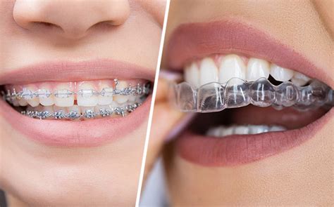 Clear Braces Vs Metal Braces Whats The Better Choice Aligner32