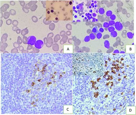 Peripheral Blood Smear Showing Presence Of Blasts With Auer Rods