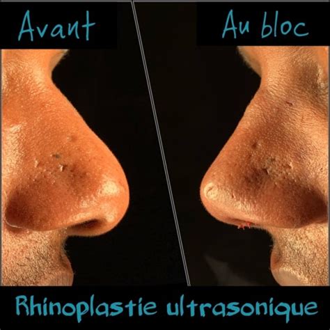 Nez ethnique à Toulon Rhinoplastie Chirurgie du nez Dr Raza