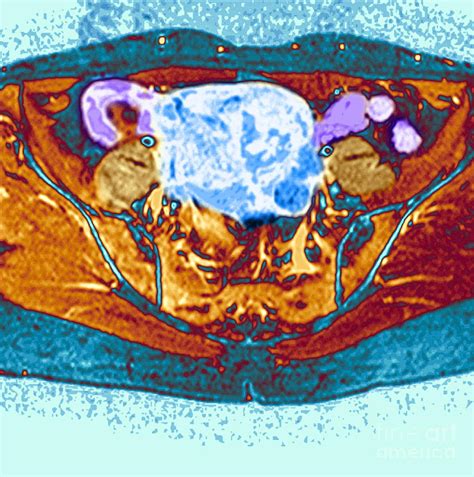 Uterine Fibroid Photograph By Simon Frasernewcastle Royal Nhs Trustscience Photo Library Pixels