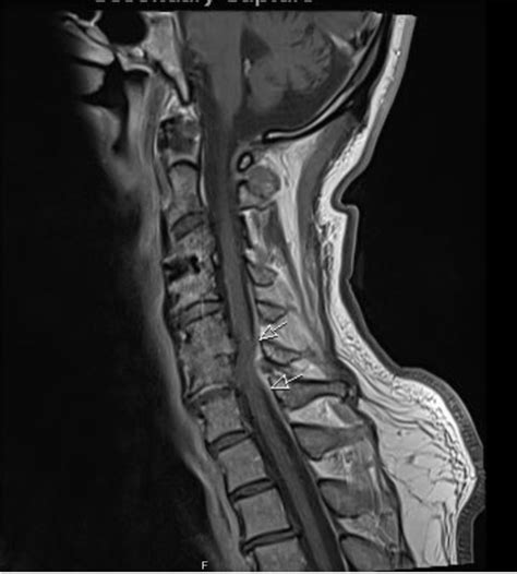 Arthritis Cervical Spine Mri